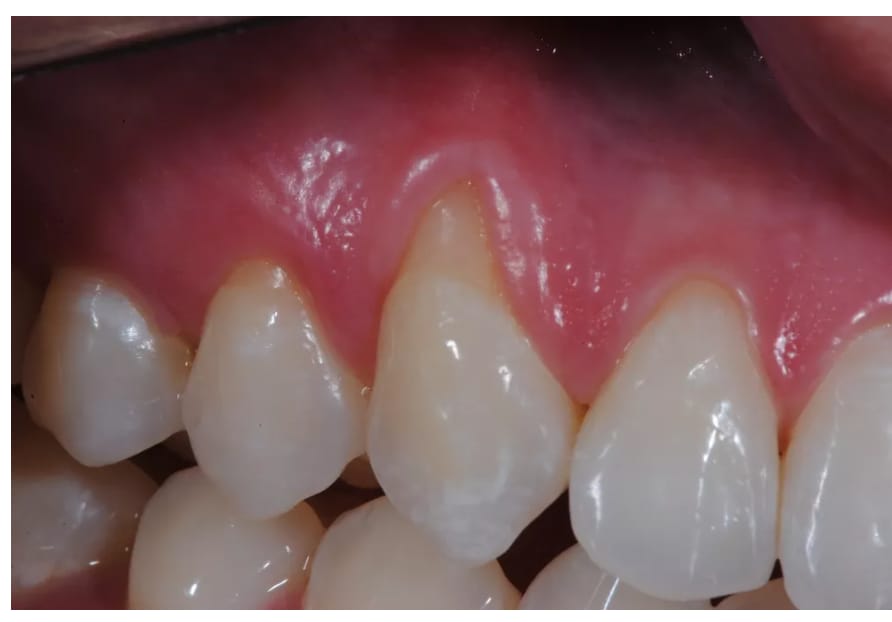 O Refluxo Gastroesofágico pode causar prejuízos irreversíveis no dente