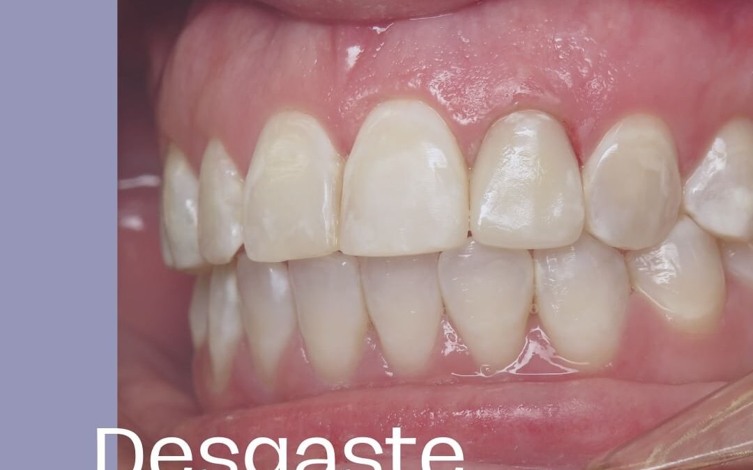 Desgaste Dentário após cirurgia bariátrica